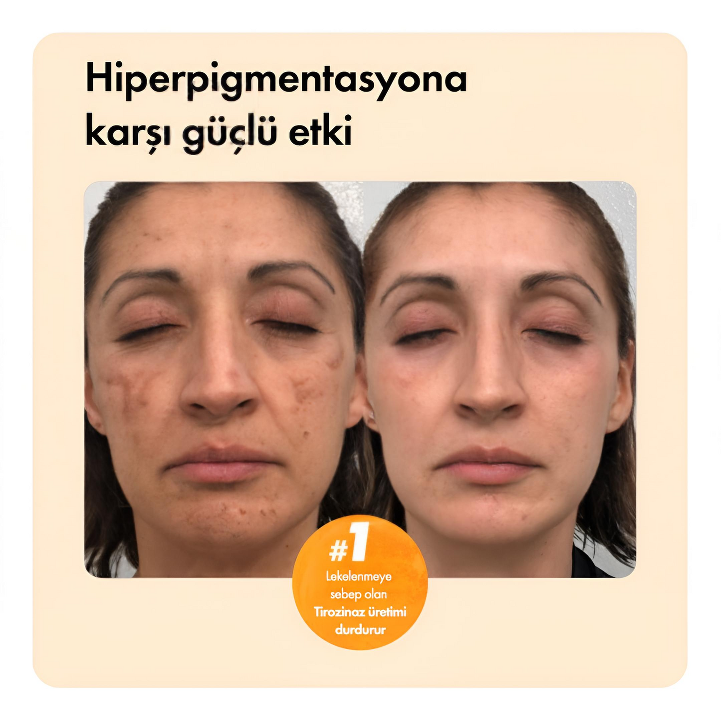 Leke Karşıtı Zerdeçal ve Kojik Asit Sabunu – Cilt Tonu Eşitleyici & Aydınlatıcı Etkili