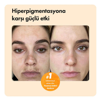Leke Karşıtı Zerdeçal ve Kojik Asit Sabunu – Cilt Tonu Eşitleyici & Aydınlatıcı Etkili