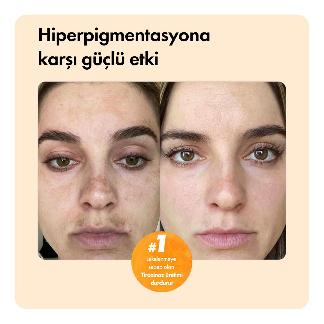 Leke Karşıtı Zerdeçal ve Kojik Asit Sabunu – Cilt Tonu Eşitleyici & Aydınlatıcı Etkili
